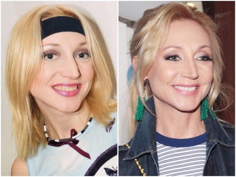Страшно красивые: 40 фото знаменитостей до и после пластических операций